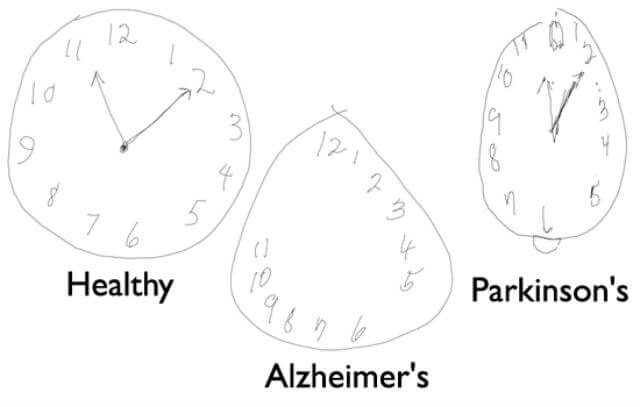 orologio-morbo-di-parkinson-alzheimer-1-1.jpg