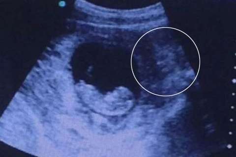 Ecografia shock in Inghilterra, compare un feto con la faccia di un demone accanto