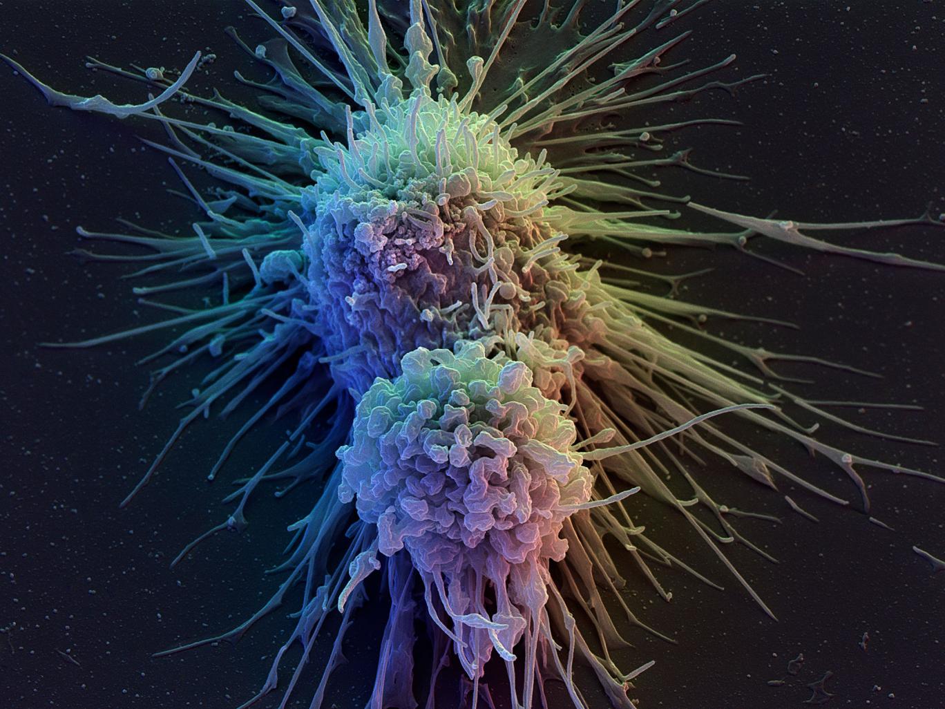 Terapia con cellule immunitarie per sconfiggere il cancro
