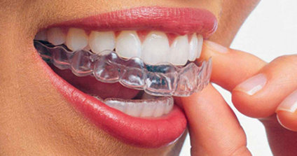 Apparecchio-denti-trasparente-Invisalign-1.jpg