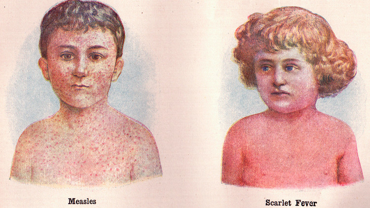 scarlattina-1.jpg