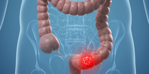 Cancro al colon: aumentano i morti, ecco i sintomi
