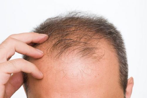 Predire la caduta dei capelli: in arrivo un metodo infallibile?
