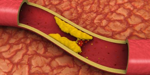 Colesterolo: una siringa per cancellarlo per sempre dal nostro corpo