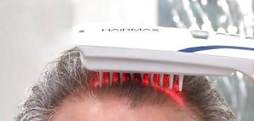 Laser per capelli funzionano davvero?