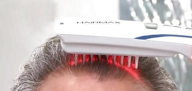 Laser per capelli funzionano davvero?