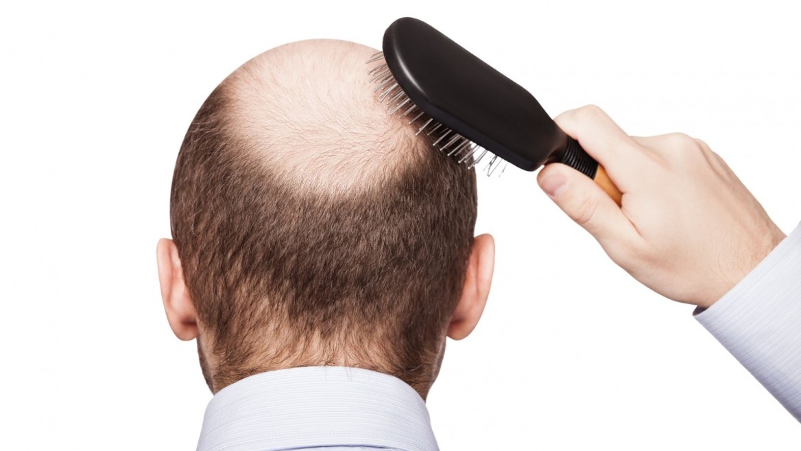 Caduta dei capelli: scoperta proteina responsabile di calvizie e capelli grigi