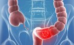 Cancro al colon: scoperto un anticorpo capace di prevenire la diffusione di cellule tumorali e metastasi