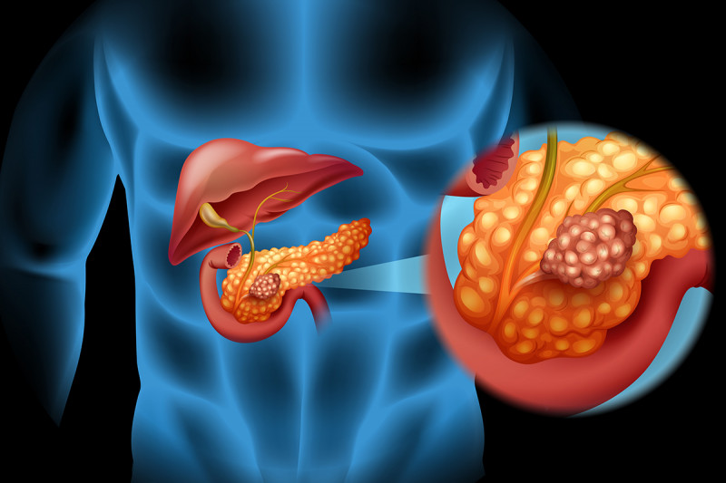 Cancro al pancreas: casi aumentati del 60%, i fattori di rischio