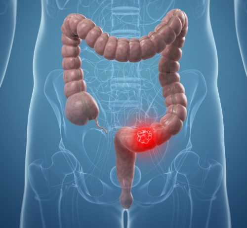Cancro al colon 