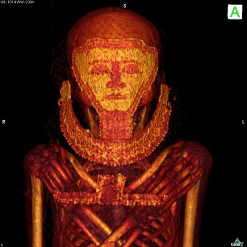 Egitto: scoperti i tumori più antichi in assoluto