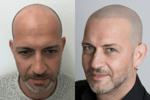 Tricopigmentazione vs Trapianto capelli vs Tatuaggio (e perché sceglierai  la prima) » Scienze Notizie