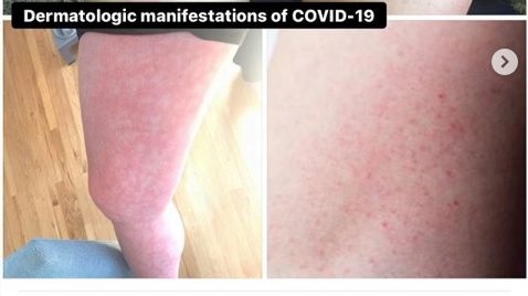 Coronavirus: le macchie sulla pelle un possibile sintomo?