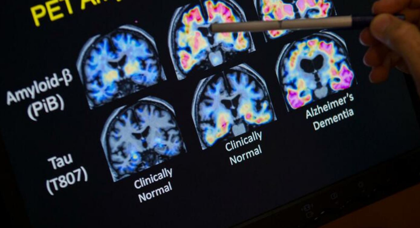 farmaco-contro-alzheimer-1.jpg