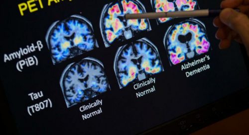 Alzheimer, svolta storica: la Fda approva il primo farmaco