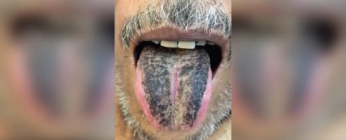 India: paziente si presenta al Pronto Soccorso con la lingua nera e ‘pelosa’