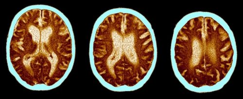 COVID: le forme gravi hanno provocato una riduzione del QI di 10 punti