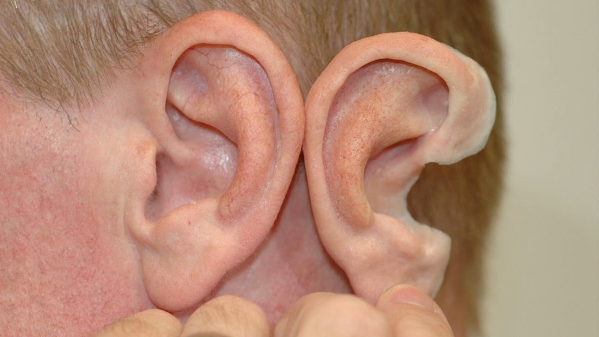 Trapiantato per la prima volta un orecchio stampato in 3D realizzato con cellule umane