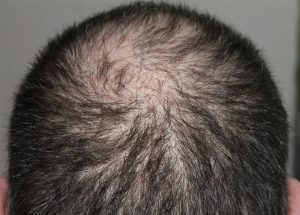 Una cura per l’alopecia areata grave. Il farmaco che darà la svolta?