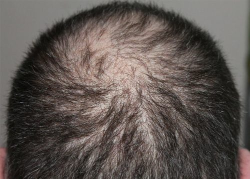La FDA approva il primo farmaco che fa ricrescere i capelli alle persone con alopecia