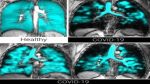 Salute: nuova tecnica di imaging polmonare mostra cosa causa il long covid