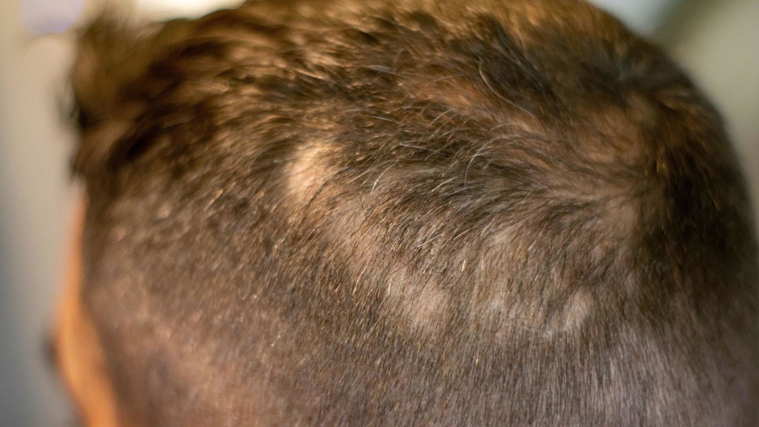 Alopecia: scoperta molecola che promuove la crescita di nuovi capelli