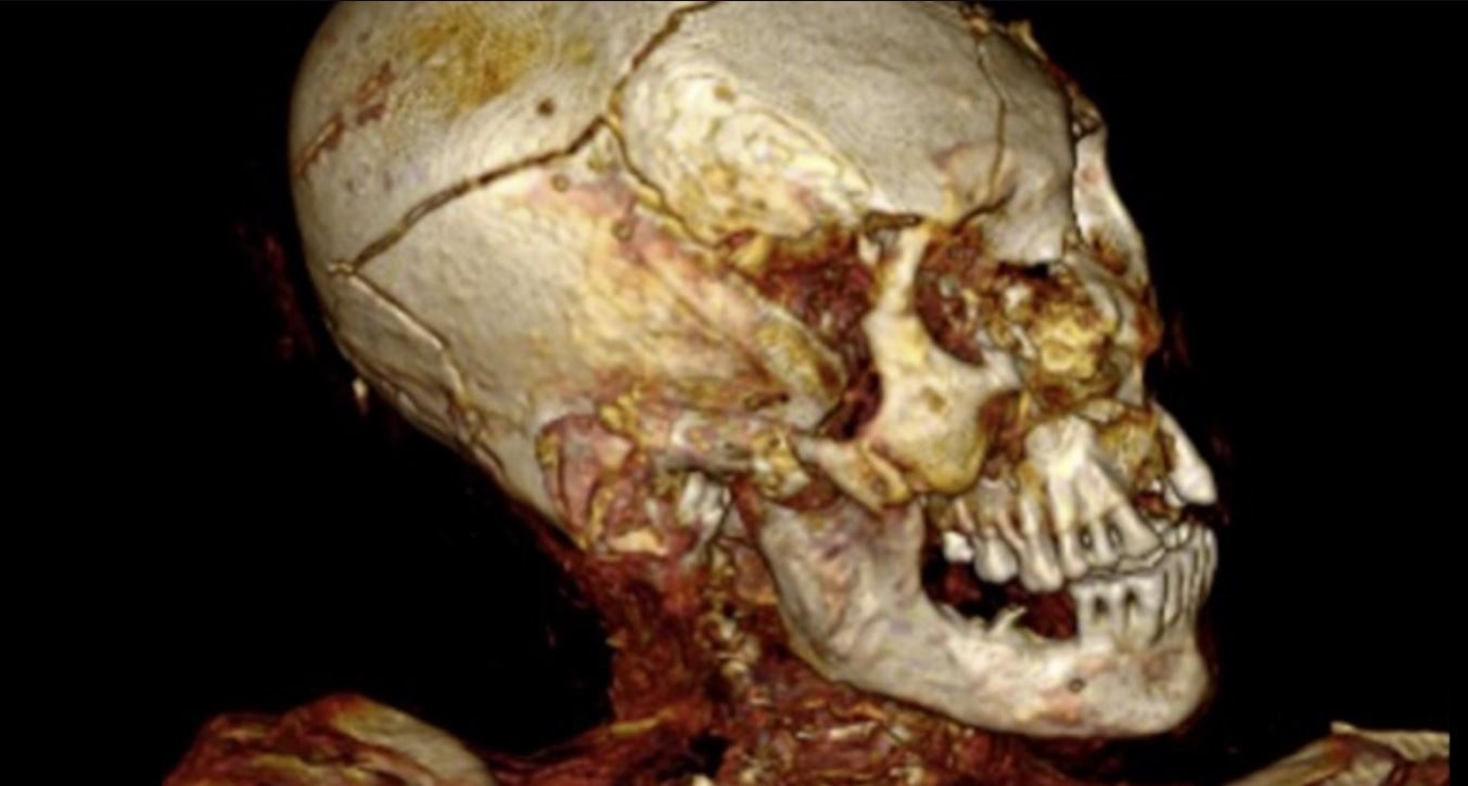 Scoperte mummie di persone brutalmente assassinate in Cile: hanno almeno 1000 anni