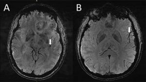 Identificate anomalie nel cervello dei pazienti affetti da emicrania