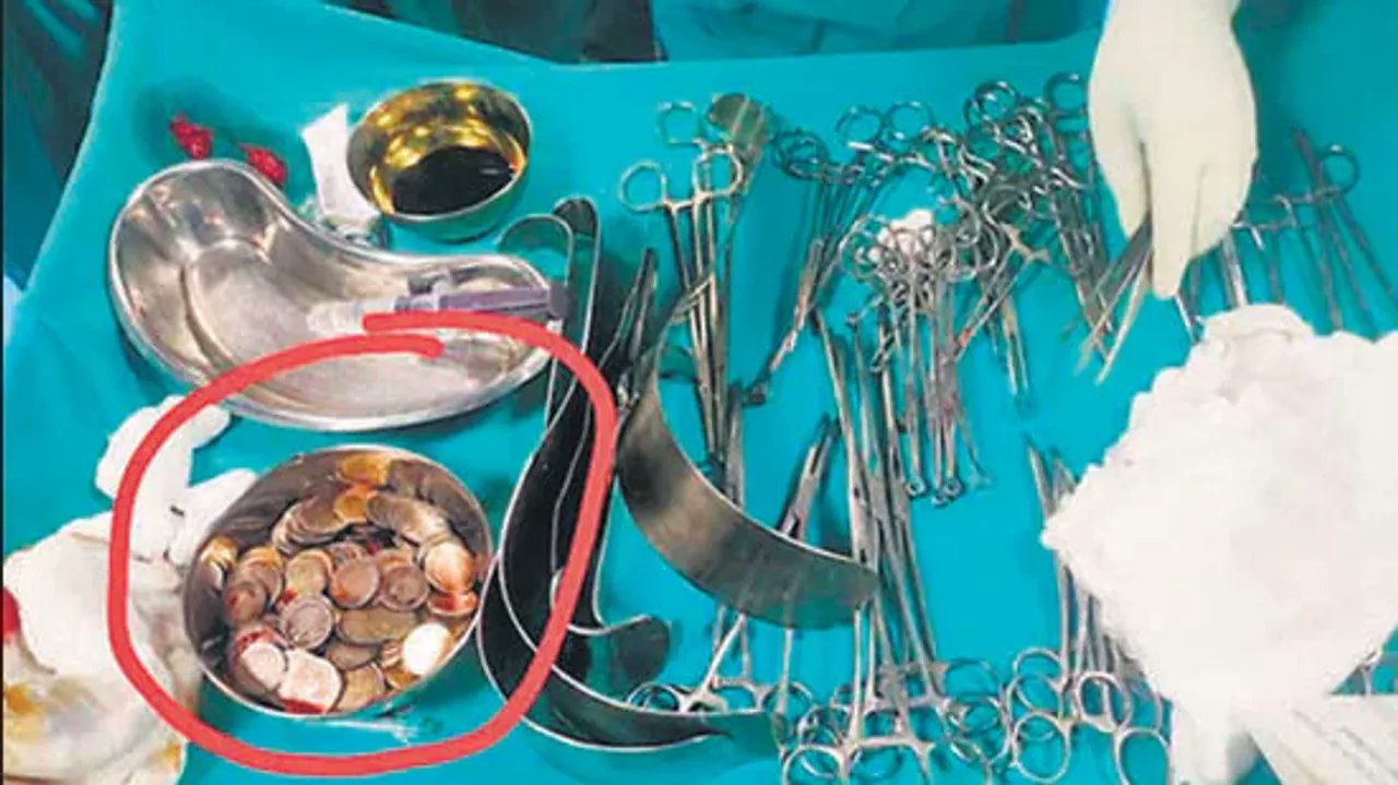Chirurghi indiani rimuovono un chilo e mezzo di monete dallo stomaco di un paziente