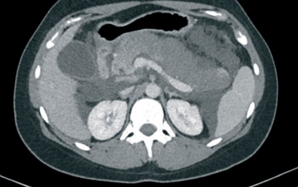 pancreatite-acuta-1-1.jpg