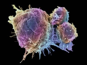 cancro al cervello