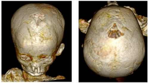 Antico Egitto: altissimi tassi di anemia nelle mummie dei bambini. I risultati della ricerca