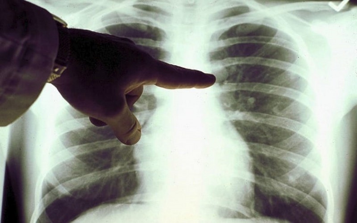 cancro-polmoni-1.jpg