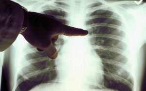 Cancro ai polmoni: scoperta una pillola che riduce il rischio di morte, risultati impressionanti 