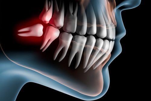 Chirurgia odontoiatrica: cos’è e quando è necessaria?