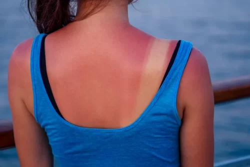L’esposizione eccessiva al sole può provocare effetti permanenti sulla pelle. Lo studio