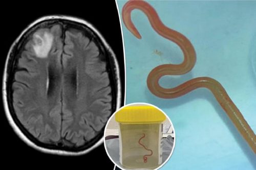 Un verme parassita estratto vivo dal cervello di una donna, primo caso al mondo