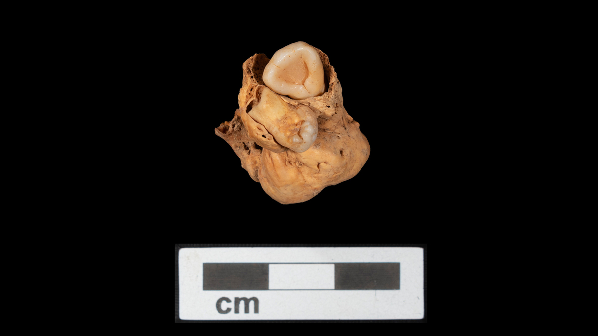 Raro tumore con denti scoperto in una sepoltura egiziana di 3.000 anni fa