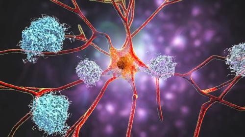 Illustrazione delle placche di amiloide nel cervello dell'Alzheimer