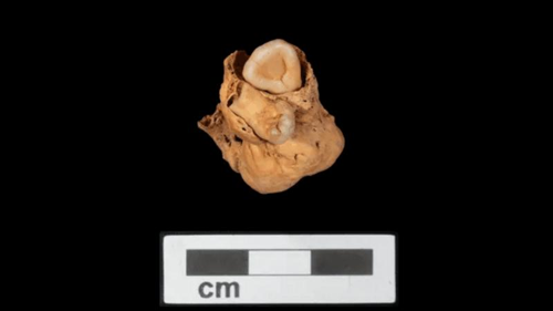 Un tumore teratoma con denti scoperto nel bacino di una donna egiziana antica.