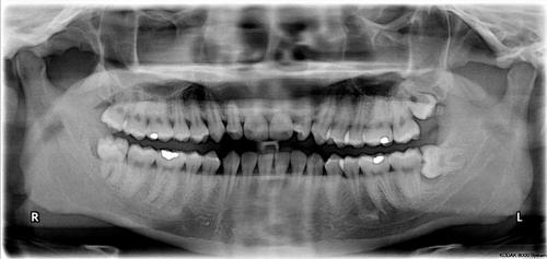 Radiografia dei denti del giudizio