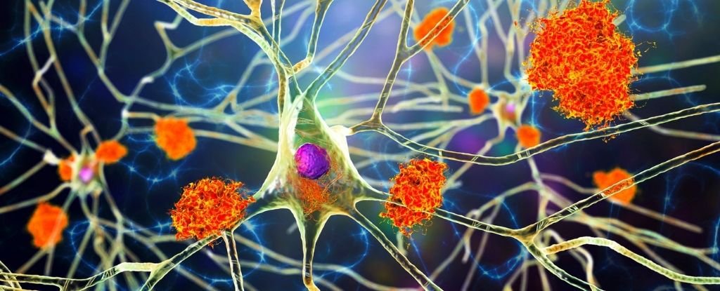 Virus e Morbo di Alzheimer: uno studio rivela un’inaspettata correlazione