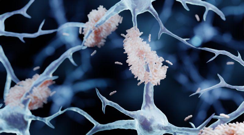 Rappresentazione 3D di neuroni con placche di amiloide (aggregazioni di piccole proteine a forma di bastoncino) che si accumulano attaccandosi ad essi