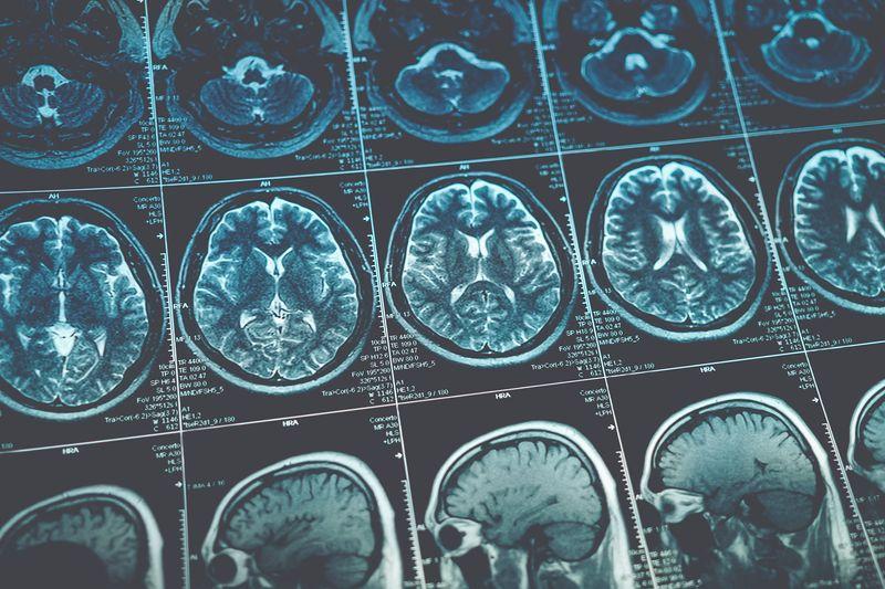 Nuova tecnica analitica rivela schemi di connettività cerebrale nell’ADHD