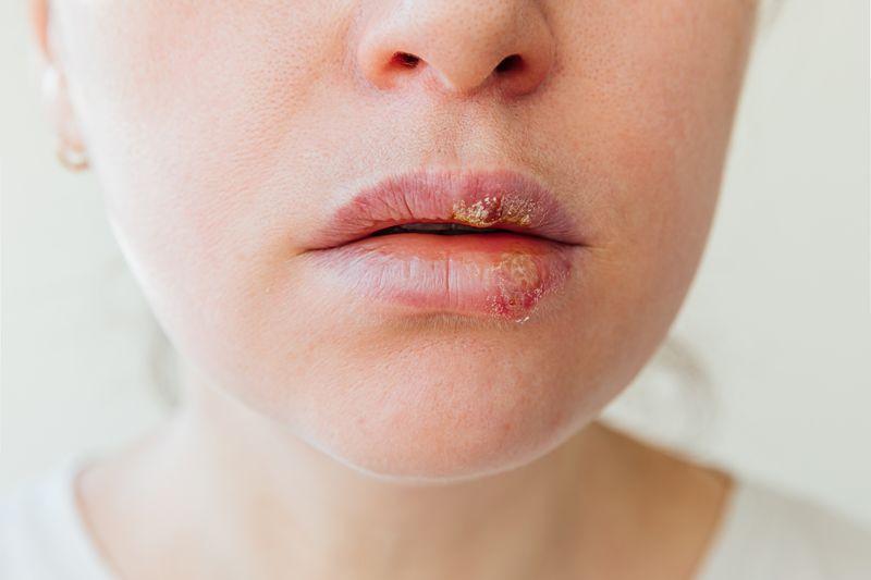 close up delle labbra di una donna colpite da herpes labiale