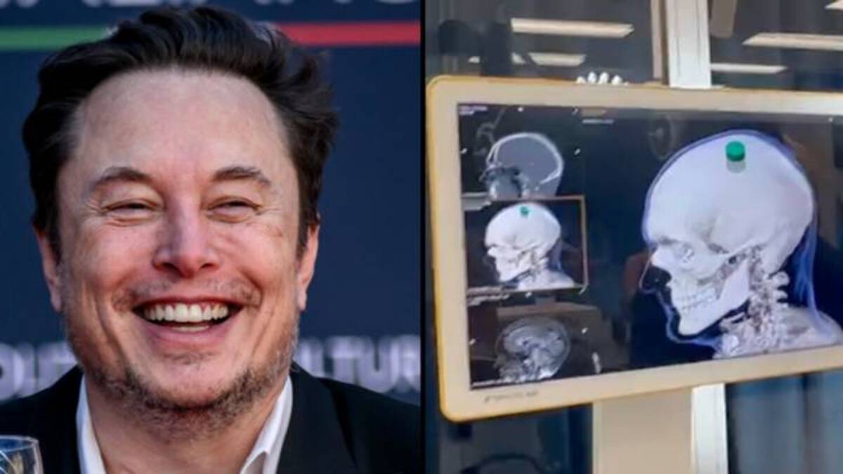 Elon Musk annuncia il primo chip impiantato nel cervello umano