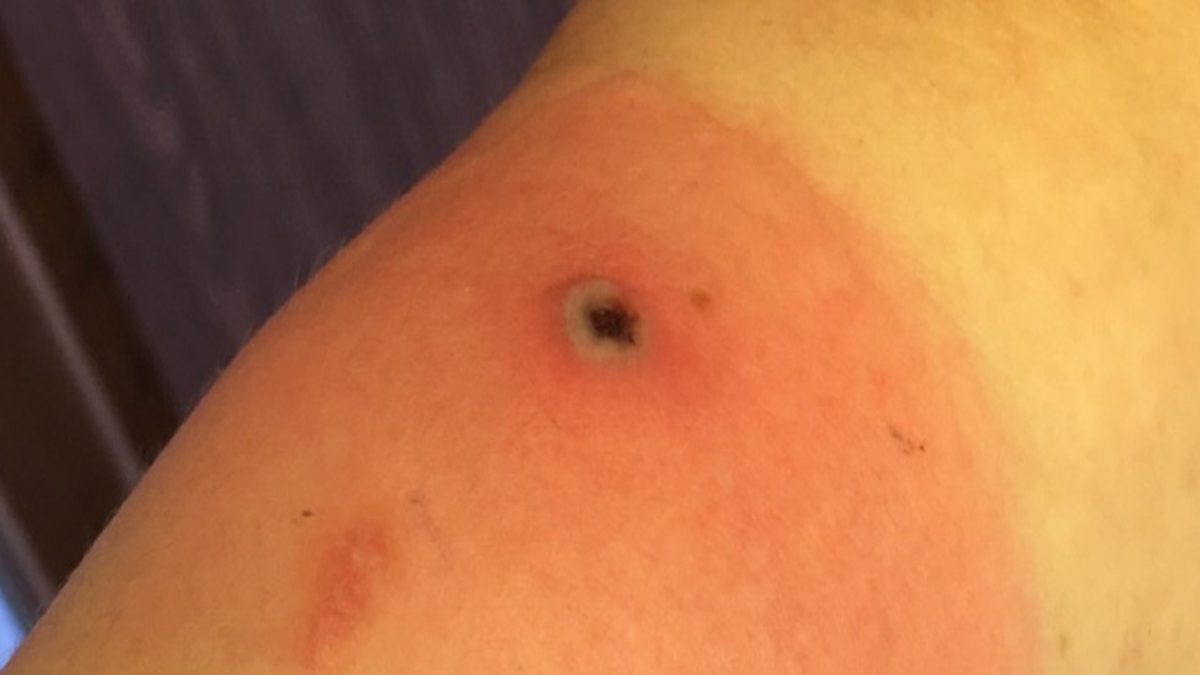 PoxLesion-1-1.jpg