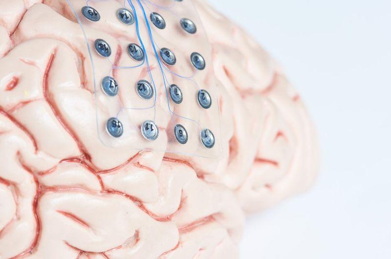 Impianto cerebrale per l'OCD e l'epilessia