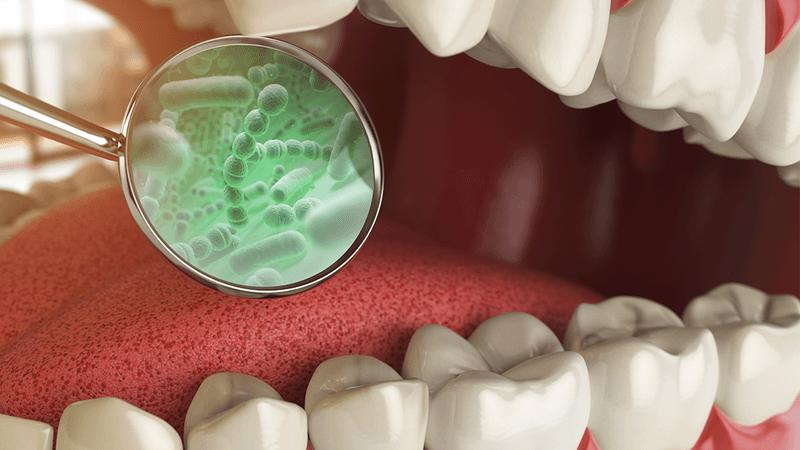 Grafica di una bocca aperta con denti e lingua. Uno strumento argentato mostra i batteri in uno stile grafico verde.