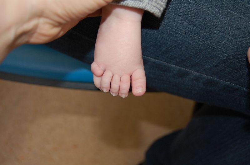 piede di uno dei pazienti neonati che mostra la polidattilia (un dito in più)
